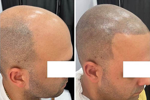 Effetto rasato